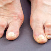 Foot ulceration in patients with rheumatoid arthritis