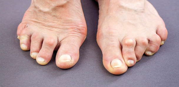 Foot ulceration in patients with rheumatoid arthritis
