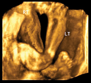 A prenatal ultrasound image of a child with bilateral clubfoot. (Image courtesy of the Boston Children's Hospital Department of Orthopedics.)