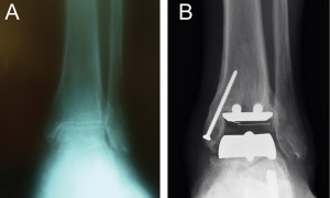 Before (A) and after (B) total joint replacement for end-stage arthritis of the ankle. (Images courtesy of James R. Jastifer, MD.)
