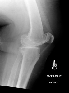 Figure 4. Lateral radiograph of left knee revealing osteoarthritis.