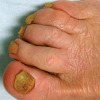 Onychomycosis remains a major clinical challenge