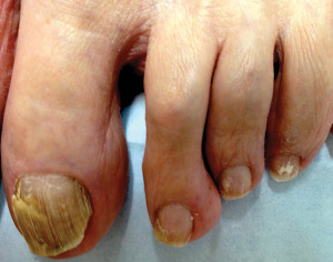 Figure 3. In this less extreme case, the nail is somewhat thickened, and the infection doesn’t extend all the way back to the nail matrix.
