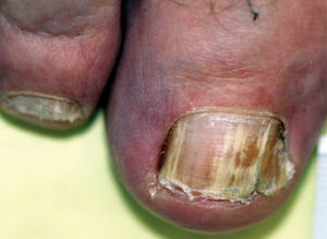Figure 4. In this case, the nail is not extremely thick and the extent of the infection is not severe. However, it does extend to the matrix, includes nail dystrophy, and the nail is split down the middle, which will complicate topical treatment.
