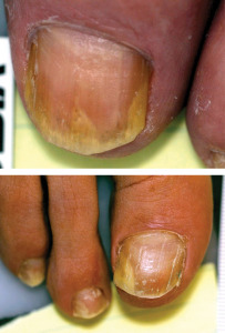 Figure 5. Both of these cases are much less severe than those in Figures 1-4. Each patient had onychomycosis for about one year. Both will likely respond to oral medications and possibly topicals.