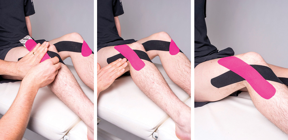 Elastic therapeutic taping application for distal iliotibial band syndrome. (Photos courtesy of RockTape UK.)