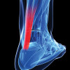 Early weight bearing after Achilles tendon repair