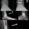 Total ankle arthroplasty: defining its clinical niche