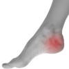 Foot orthoses for heel pain help improve walking activity