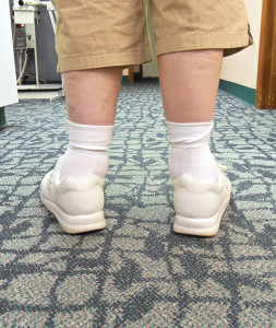 Photo of uncorrected patient, courtesy of Earthwalk Orthotics.