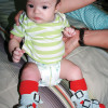Gait analysis for clubfoot may reveal long-term issues