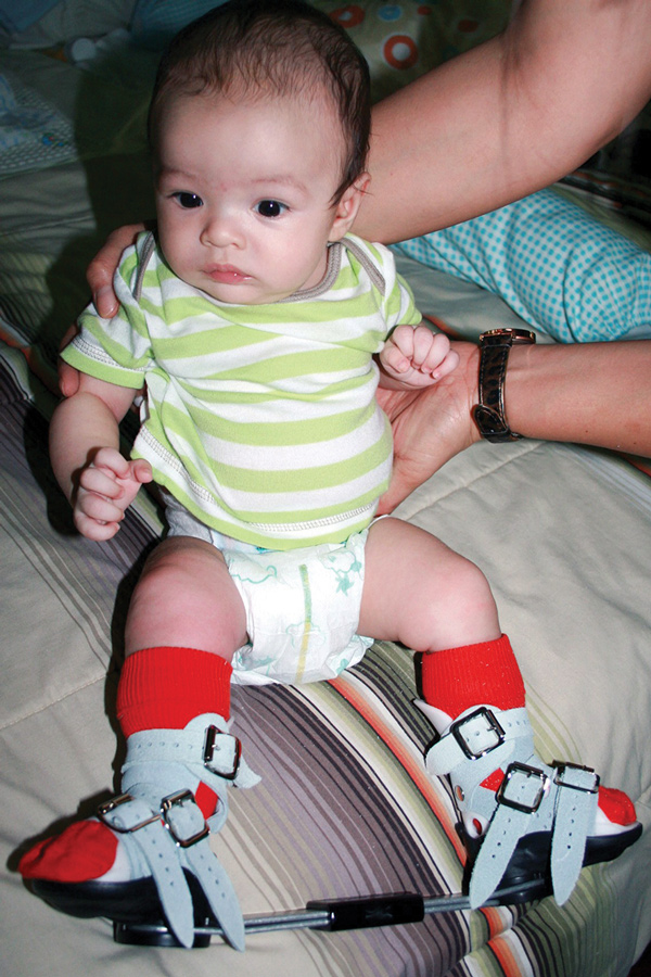 Gait Analysis For Clubfoot May Reveal Long Term Issues Lower Extremity Review Magazine