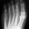 Fifth met fractures and osteoporosis in women