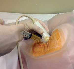 Figure 2. PRP preparation rich in growth factors (PRGF) injected under ultrasound guidance into a partial tear of the right hamstrings origin. (Photo courtesy of Omer Mei-Dan, MD.)