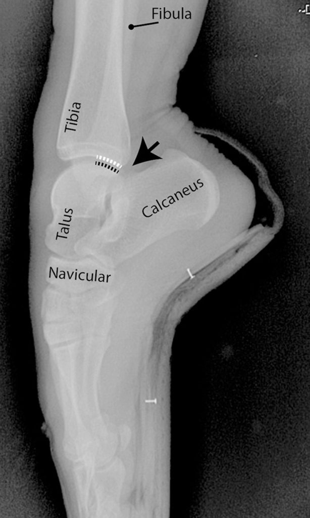Figure 2: X-ray of a ballet dancer en pointe. The black arrow points to the area where the tibia, talus, and calcaneus converge when a dancer is en pointe. The black dotted line identifies the posterior portion of the talus beyond its articular surface. The white dotted line denotes the corresponding portion of the tibia’s articular surface that rests against the posterior talus in this position.