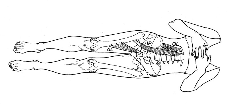 Functional limb-length discrepancy. Contracture of the quadratus lumborum (QL), iliopsoas (IP), and/or adductor longus (AL) muscles frequently results in a functionally shortened limb. (Reprinted with permission from reference 10.)