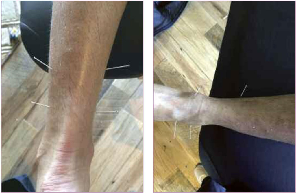 Figure 2. Professional baseball player (not the same as in figure 1) with an anterior ankle impingement. Dry needling was performed at the syndesmosis, posterior tibialis, and ankle joint. (Photo courtesy of Sue Falsone, PT, MS, SCS, ATC, CSCS, COMT.)