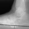 Cuboid height revisited: Study disputes link to Charcot ulcers
