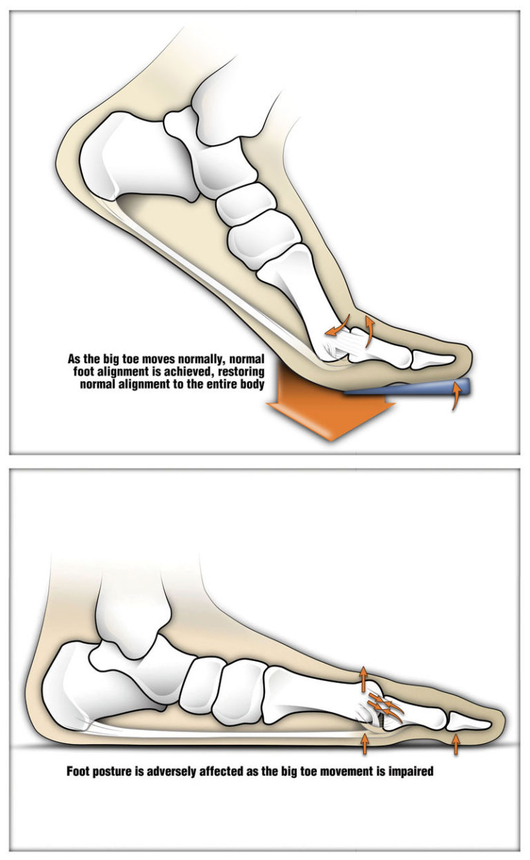 Orthotic management tactics for hallux limitus Lower Extremity Review Magazine