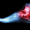 Researchers target prevention of posttraumatic osteoarthritis