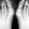 Study finds little difference between DMO and PMO for hallux valgus