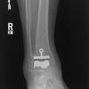 AA vs TAA: Update on ankle arthroplasty