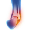 Management of acute ankle sprains: To immobilize or not?