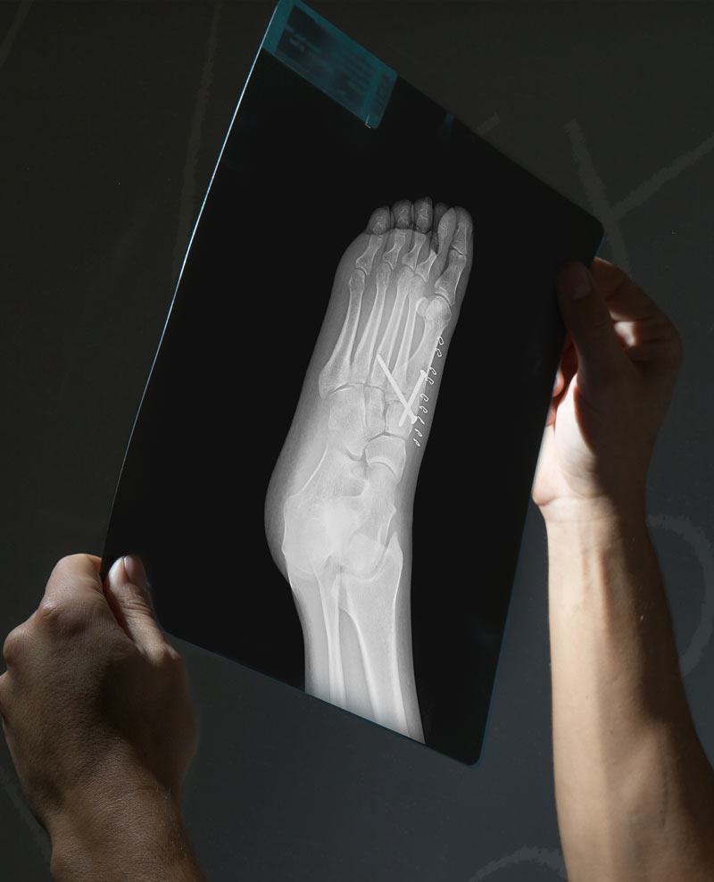 Stress Fractures Of the Foot in Football | Lower Extremity Review Magazine