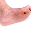 Low Cost Insulin Spray Improves Healing of Diabetic Foot Ulcers