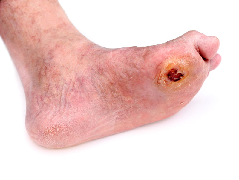 Low Cost Insulin Spray Improves Healing of Diabetic Foot Ulcers