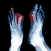 Office-based Toe Amputations Are Safe and Efficient