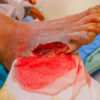 Negative Pressure Wound Therapy Creates Positive Clinical Outcomes in an Outpatient Setting