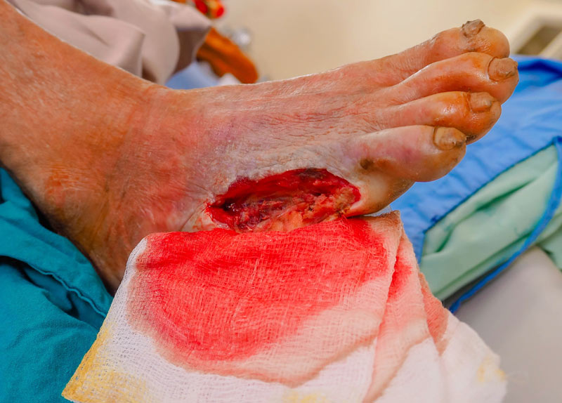 Negative Pressure Wound Therapy Creates Positive Clinical Outcomes in an Outpatient Setting
