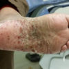 Case: A Woman with Blistering, Erythema, and Scaling of the Feet