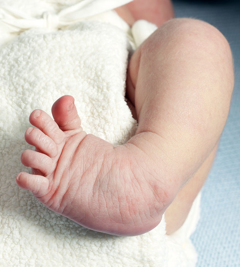 New Tool to Assess Clubfoot Treatment