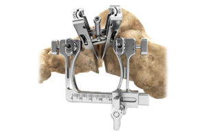 PediFoot Deformity Correction System