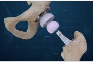 Conformis Hip System Features iFit Image-to-Implant Technology
