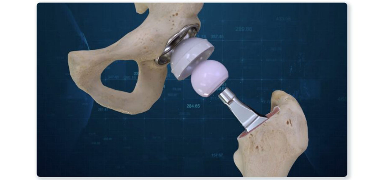 Conformis Hip System Features iFit Image-to-Implant Technology