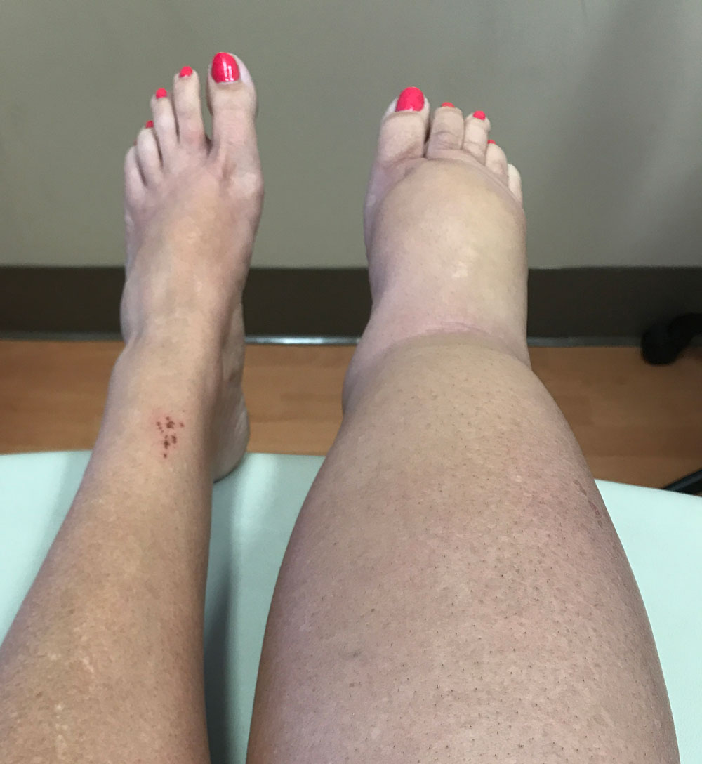 List 91+ Images pictures of lymphedema in legs Sharp