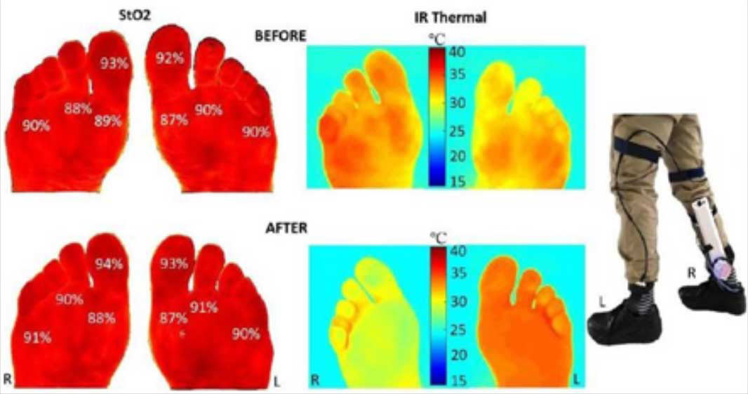 Cooling Insoles Offer New Approach to Diabetic Foot Ulcer Prevention