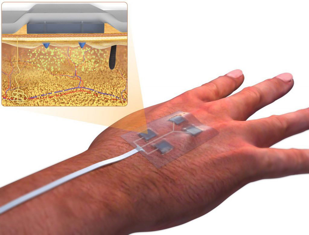 UCONN BIOMEDICAL ENGINEER CREATES SMART BANDAGES TO HEAL CHRONIC WOUNDS
