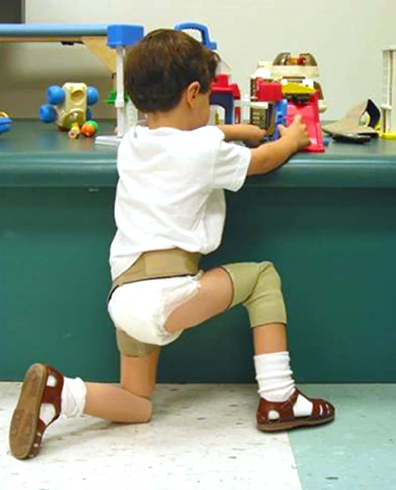Young Children Can Benefit From Articulating Knee Prosthesis