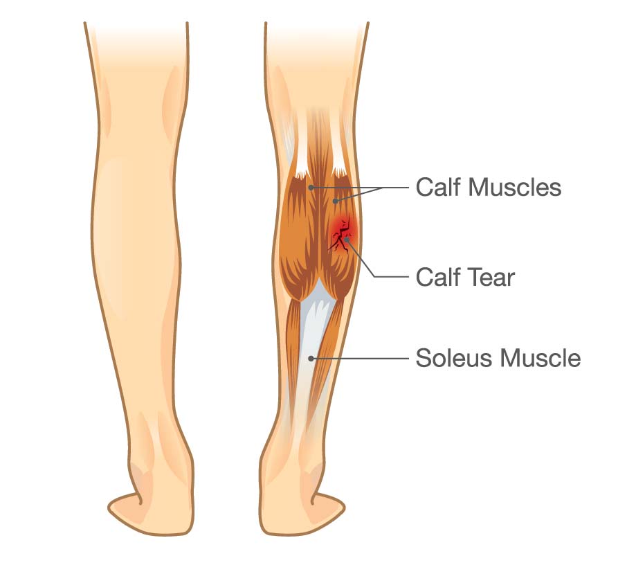 Calf Muscle Strain, Lower Extremity