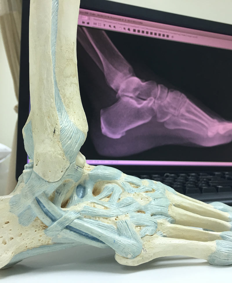 Expanding Our Understanding of Chronic Ankle Instability