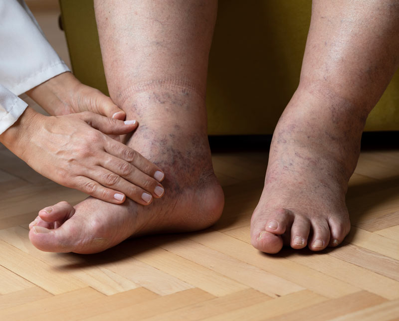 Pain Reduction Methods for Peripheral Neuropathy