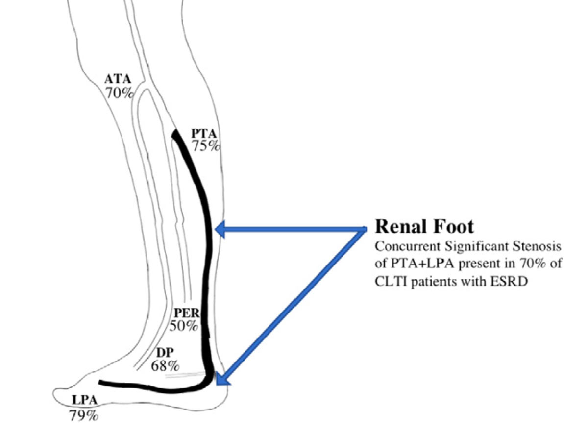 “Renal Foot” – Angiographic Patterns in Chronic Limb Threatening Ischemia + Renal Disease