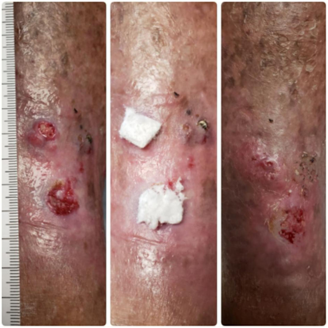 Wound Care Update: Can Bioabsorbable Borate-based Glass Fibers Support Wound Healing?