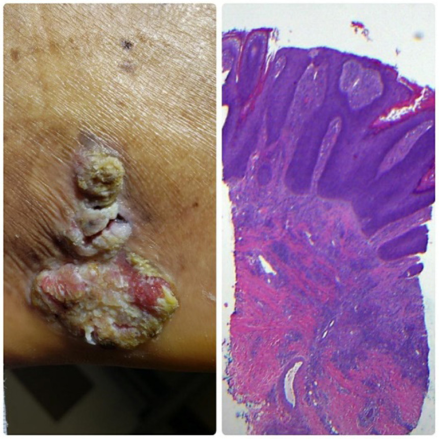 Wound Care Update: A Case of a Misdiagnosed Neoplastic Wound of The Foot