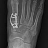 Patient Guidance: Bunion Surgery Options