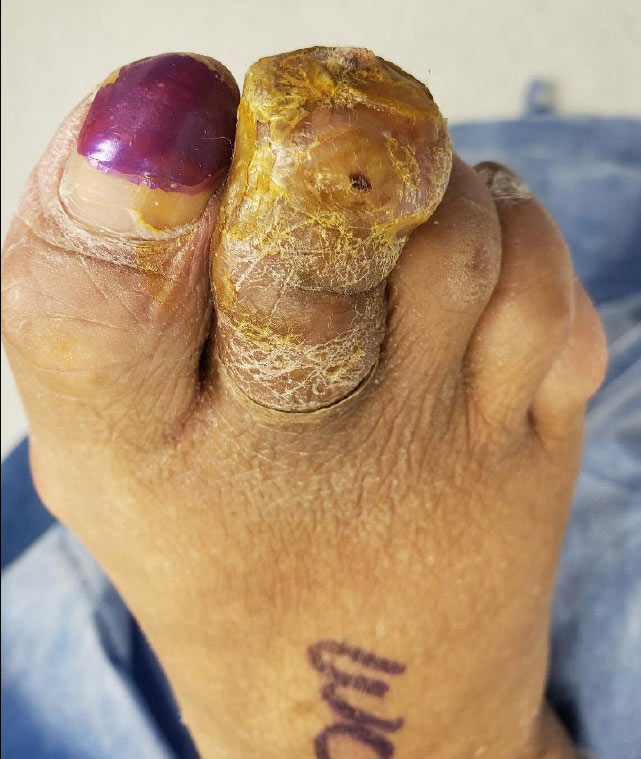 Wound Care Update: Surgical Site Dehiscence in the Foot: Risk Factors and Prevention
